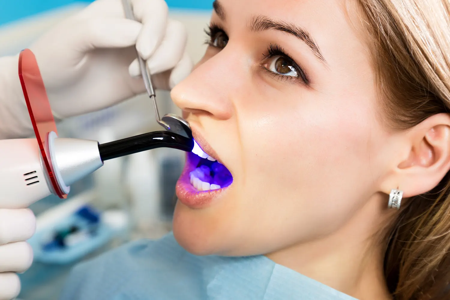 Dental Bonding in Rancho Santa Margarita | Express Dental Studio
