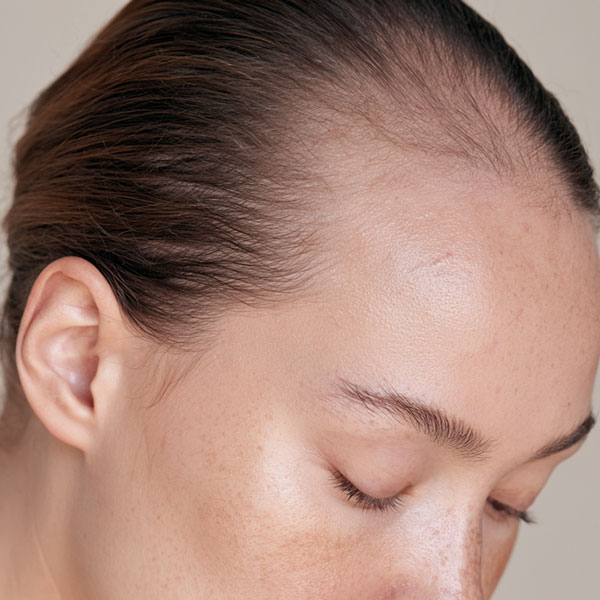 Frontal Fibrosing Alopecia