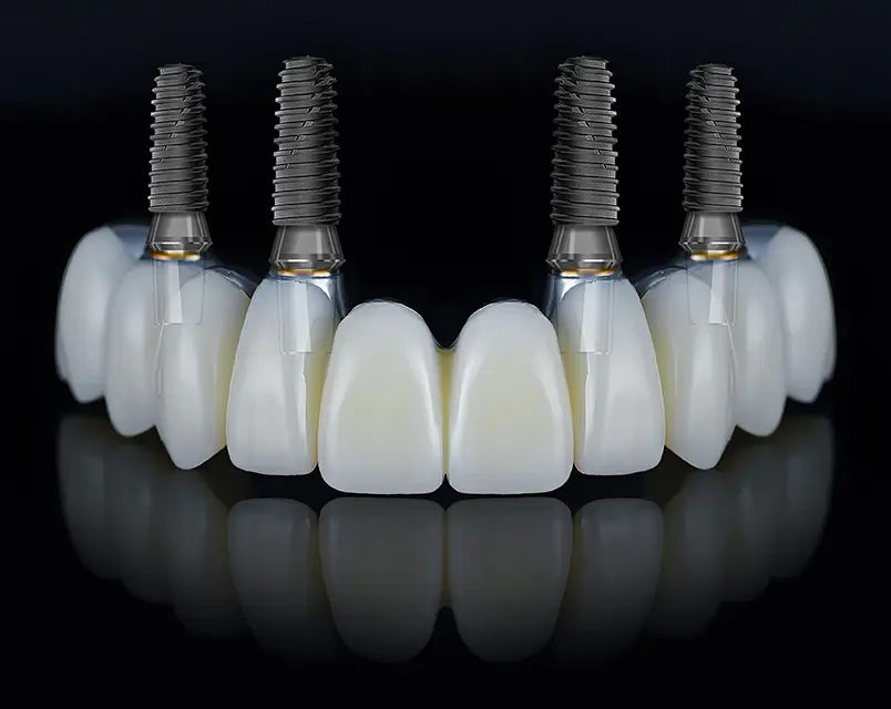 Full Arch / All-on-4