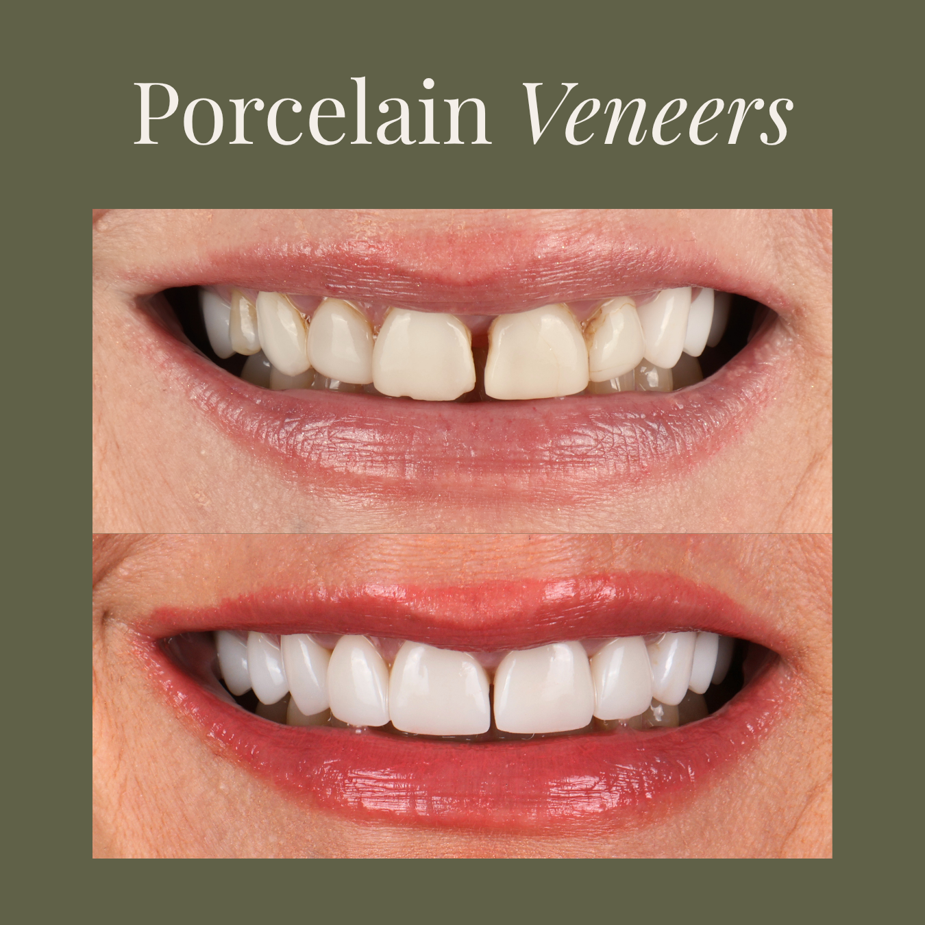 Before and after smile makeover showing six porcelain veneers custom designed to match existing dental work by a cosmetic dentist in Chattanooga, TN.