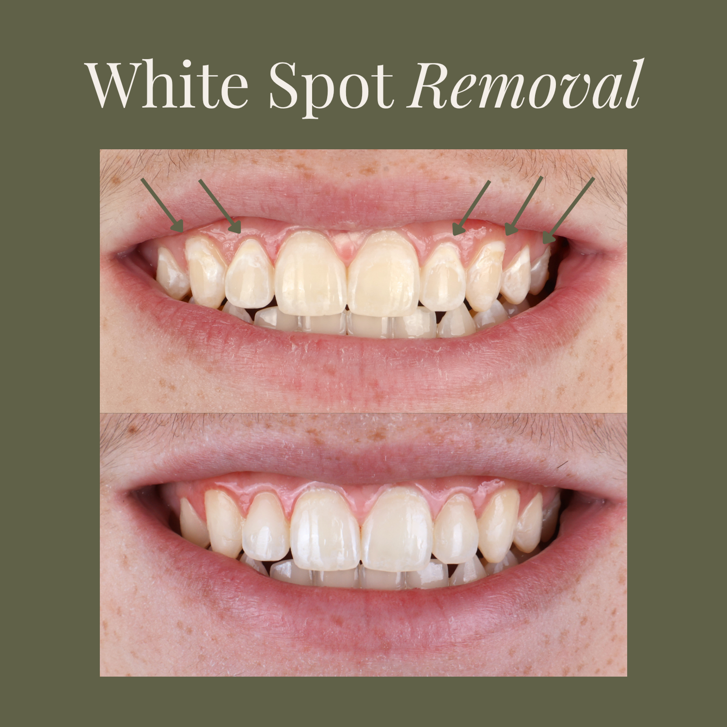 Before and after ICON treatment showing white spot removal on upper front teeth at MDRN MUSE Dental Aesthetics in Chattanooga, TN.