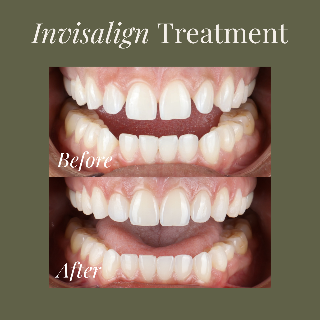 Patient smiling after Invisalign treatment at MDRN MUSE Dental Aesthetics in Chattanooga, TN, demonstrating the confidence and cosmetic benefits of clear aligner treatment.