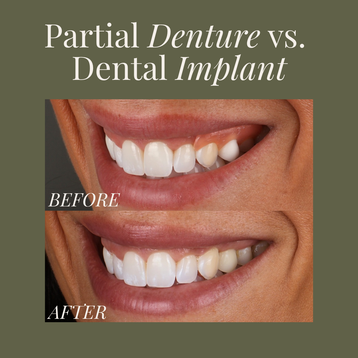 Dental implant vs partial denture comparison at MDRN MUSE Dental Aesthetics in Chattanooga TN