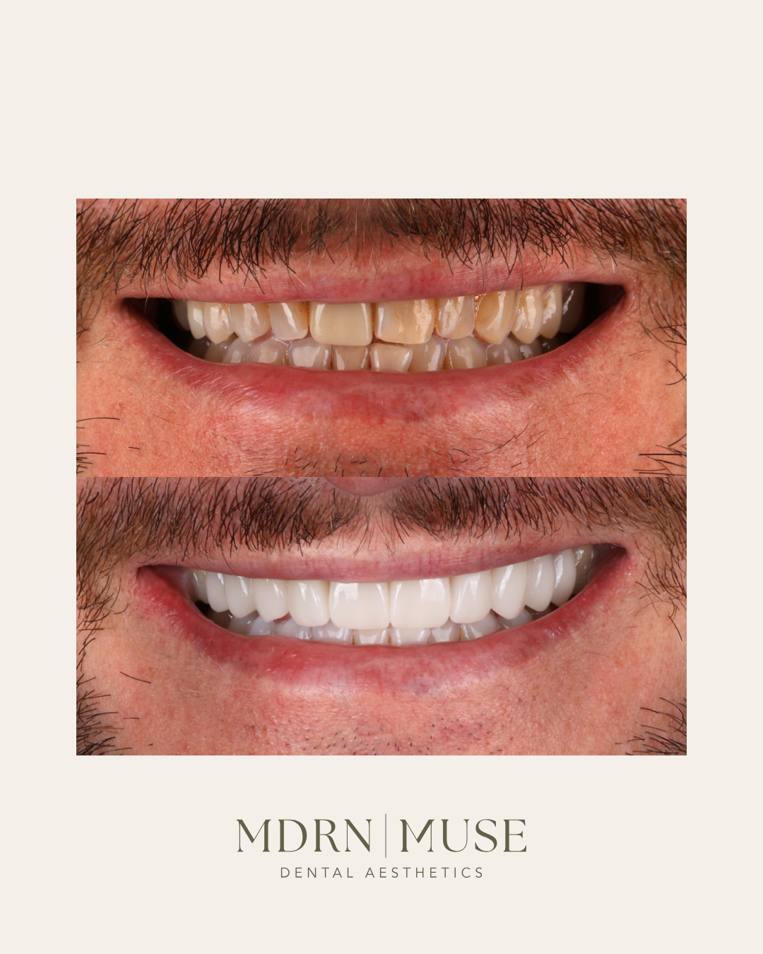 Sean's smile makeover before and after at MDRN MUSE Dental Aesthetics in Chattanooga, TN. Treatment performed by Dr. Zack Youngblood included professional teeth whitening and 10 porcelain crowns.