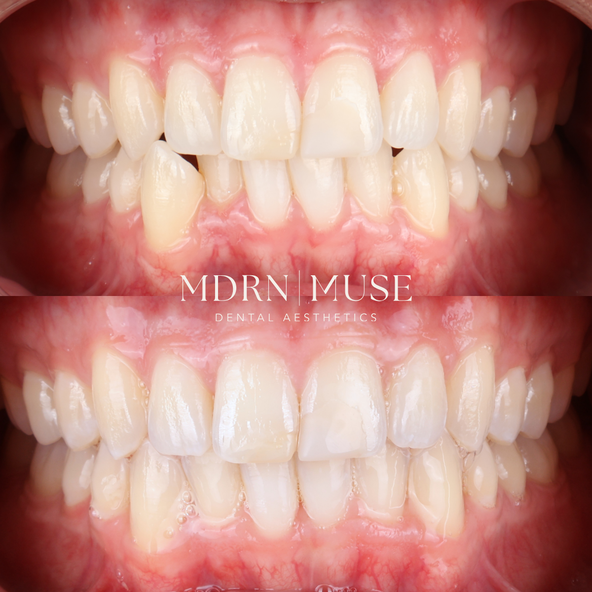 Close-up dental photos showing successful crossbite correction with Invisalign clear aligners at MDRN MUSE Dental Aesthetics in Chattanooga, Tennessee.