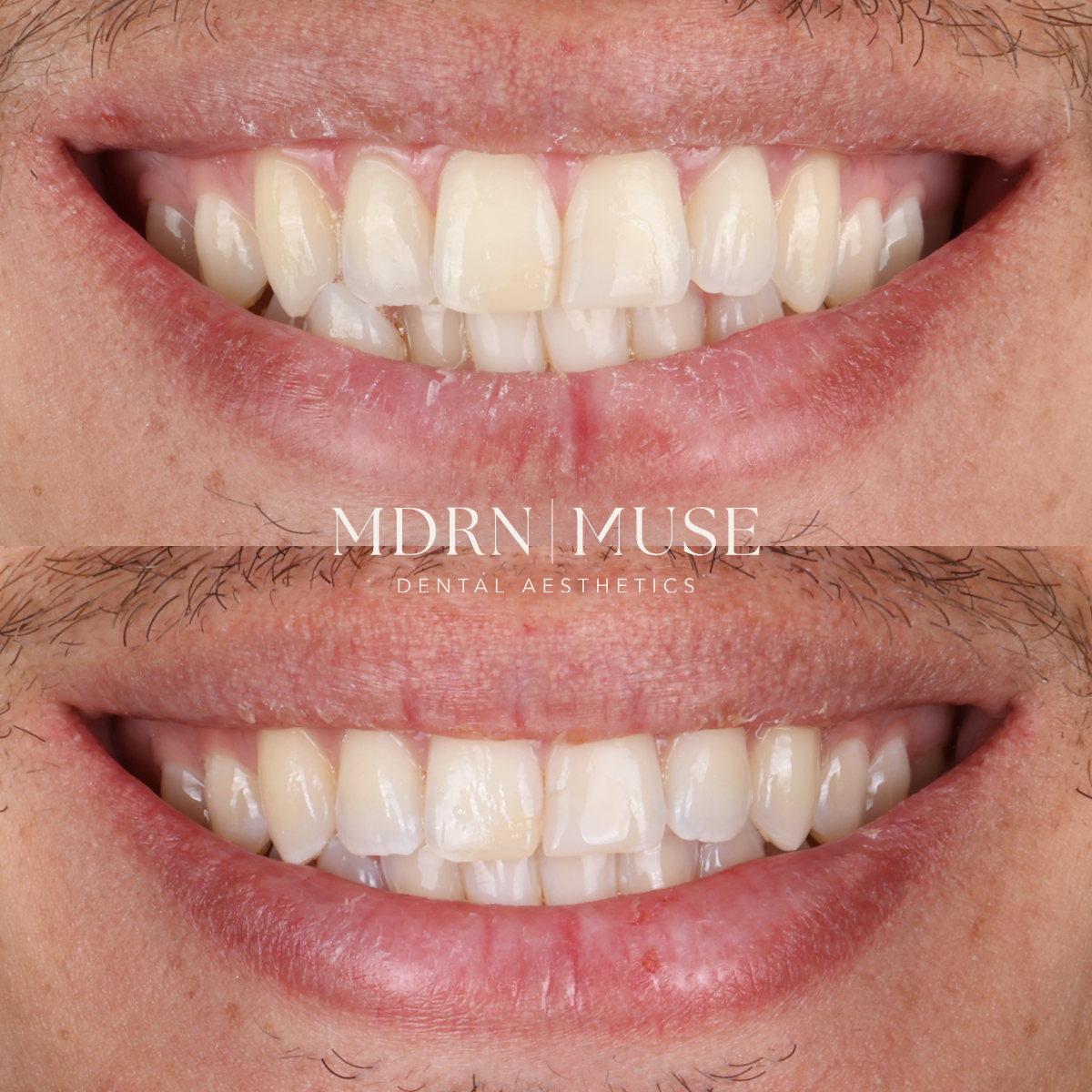 Before and after Invisalign smile transformation showing corrected dental crowding and straighter teeth by Dr. Zack Youngblood in Chattanooga, TN.