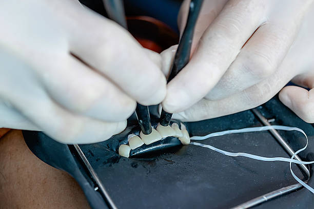 Dentist Pressing Veneers on Isolated Front Teeth stock photo