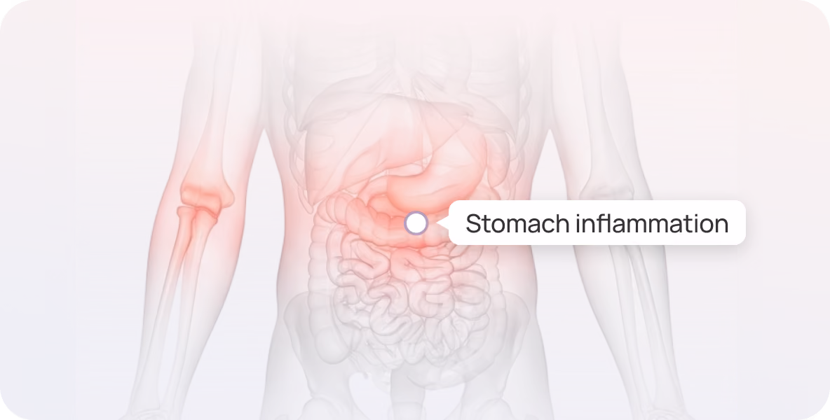 Medical illustration of a transparent human torso highlighting the stomach and nearby intestines in red to indicate stomach inflammation, with a label pinpointing the inflamed stomach area.