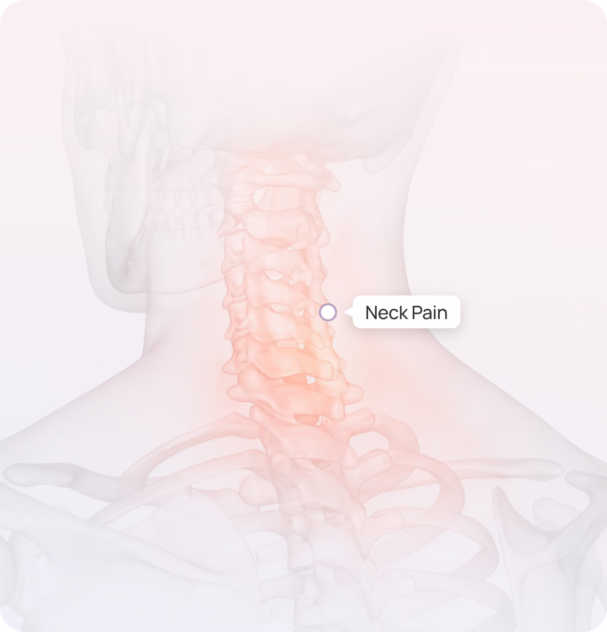 Medical illustration of the back of a human neck and upper back showing the cervical spine highlighted in red to indicate neck pain.