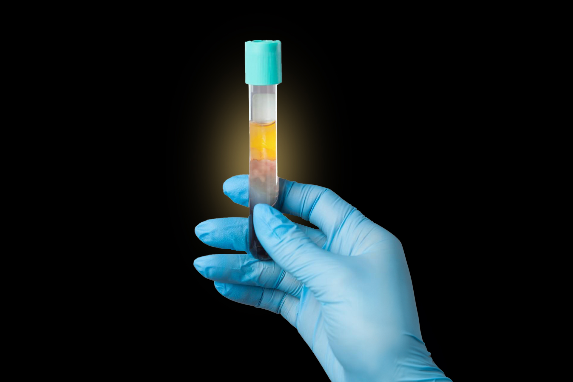 Platelet Rich Plasma