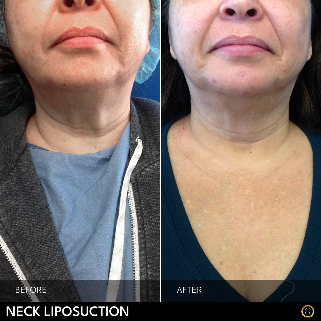 This patient received neck smart liposuction to help remove fat and help define the jaw.