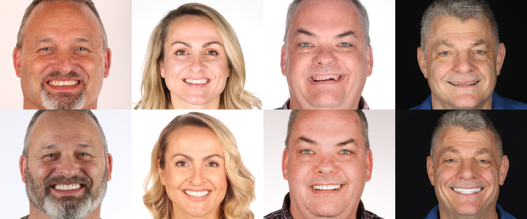 Full Arch Rehab (Crowns and Veneers)