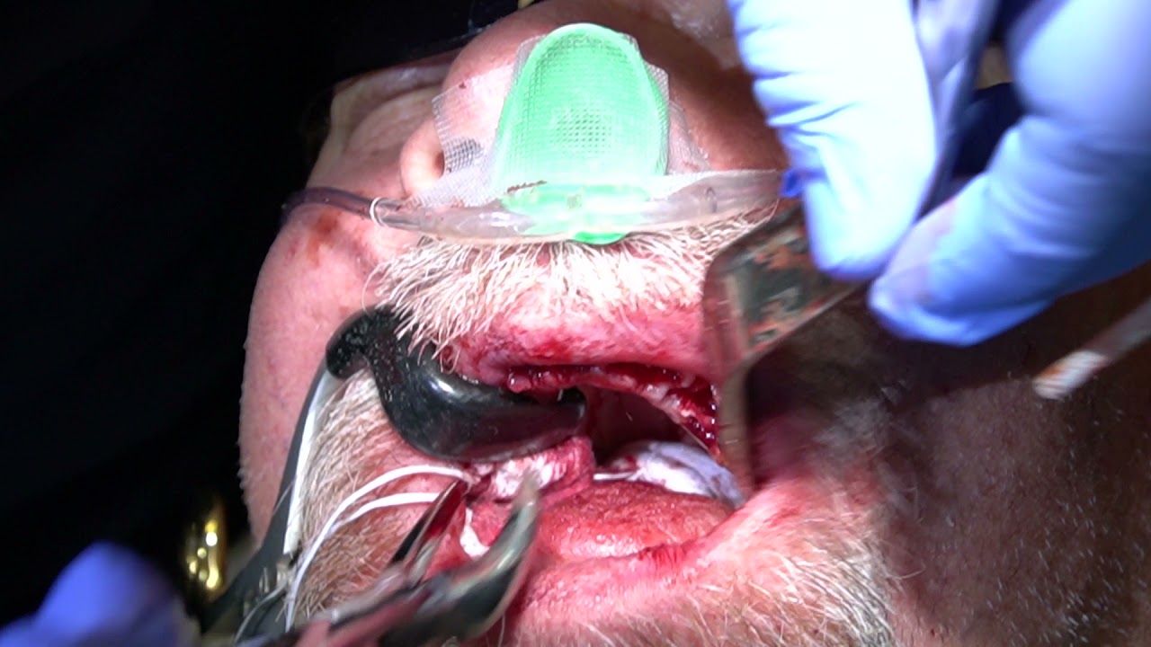 Full Arch Surgery | Pre-Course Didactics