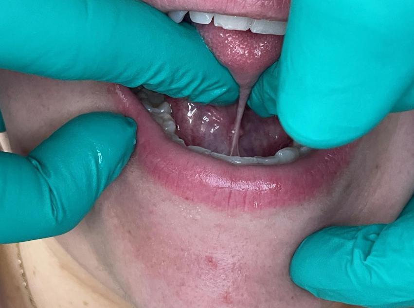Frenectomy - March 10th-11th, 2027