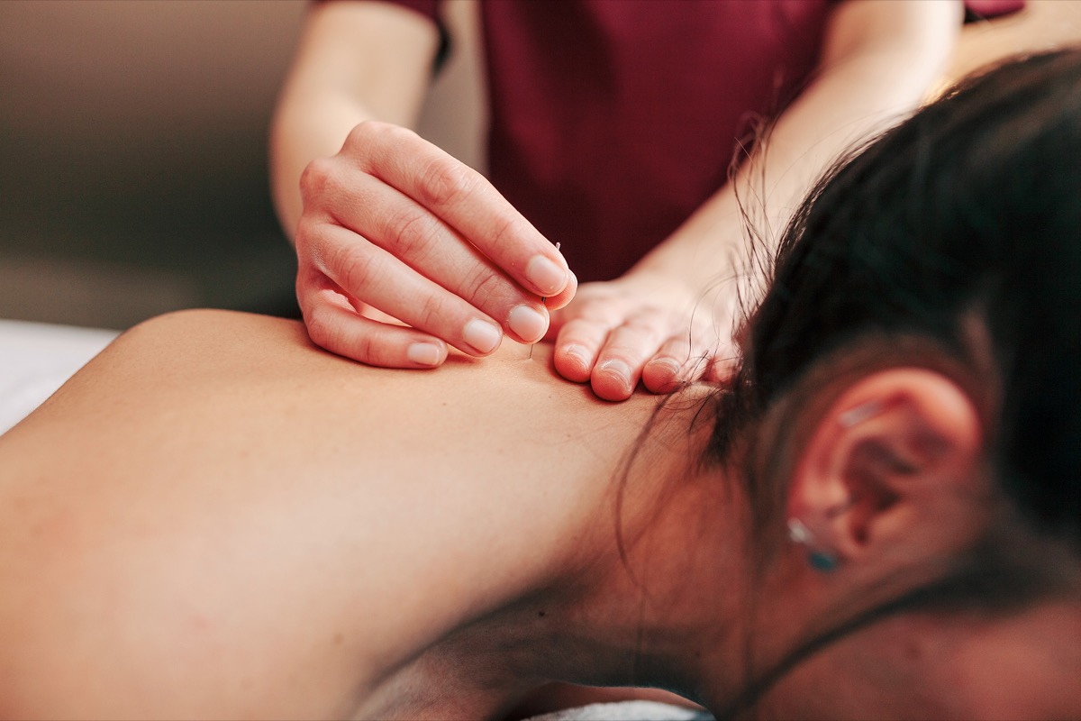 Dry Needling am Nacken