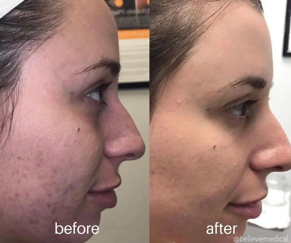 Microneedling before and after — texture and tone