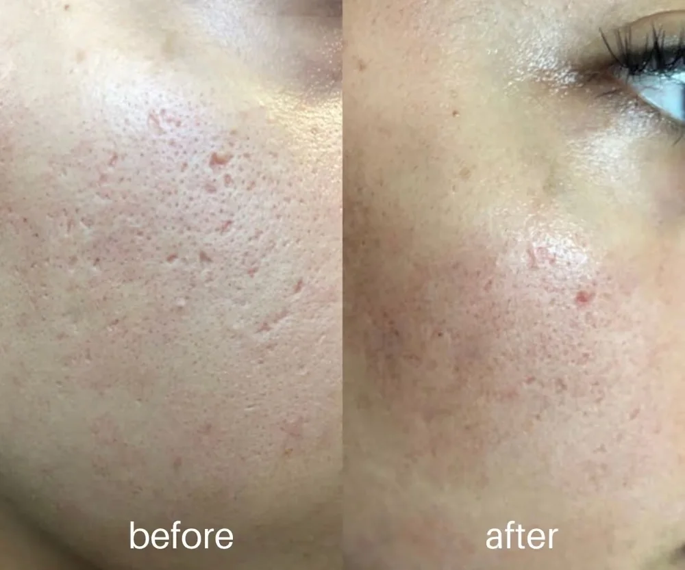 Microneedling before and after — acne-scar smoothing