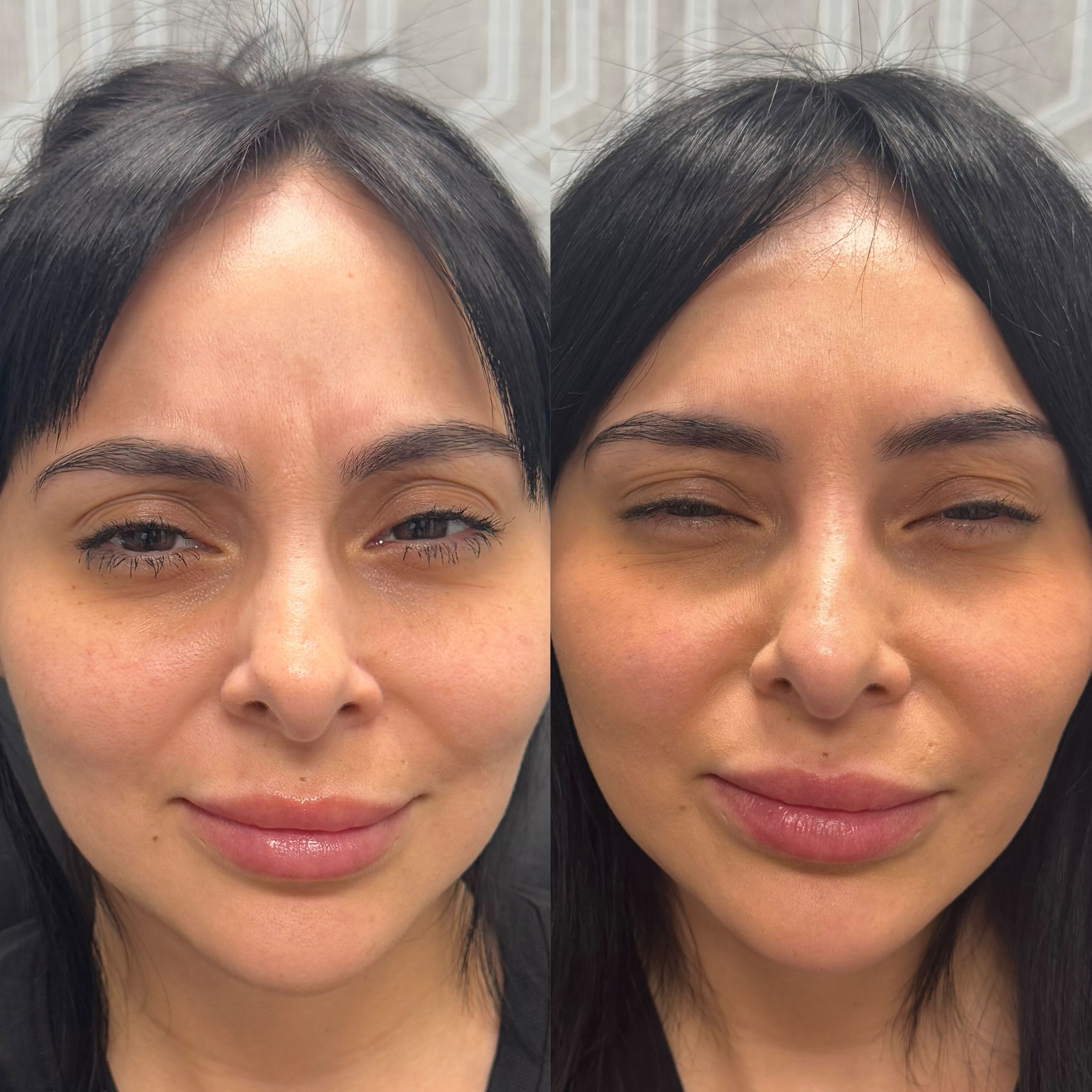 Before and after a wrinkle relaxer treatment