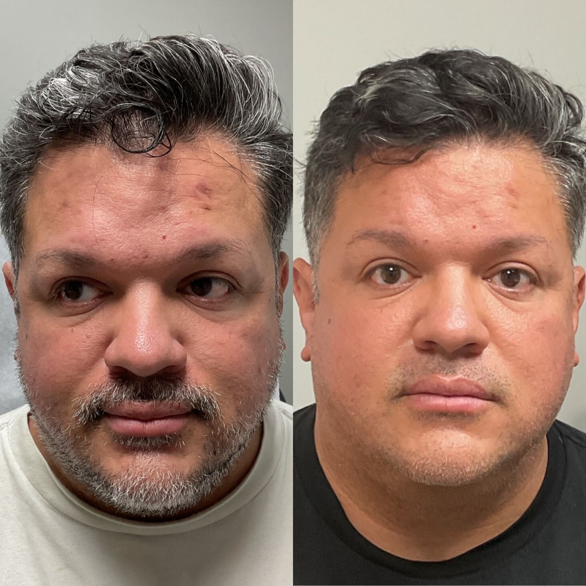 Before and after VI Peel treatment from Belle Vie’s published patient gallery
