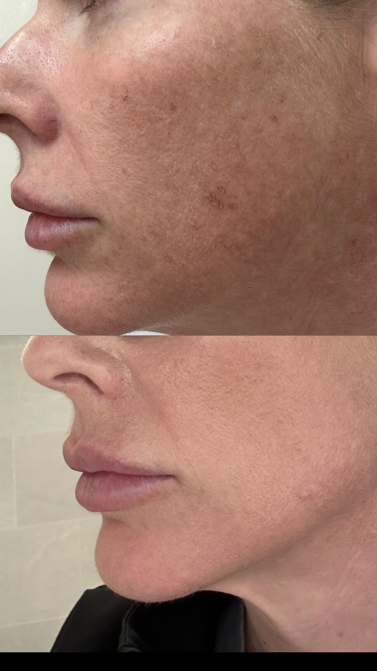 Before and after IPL photofacial treatment from Belle Vie’s published patient gallery