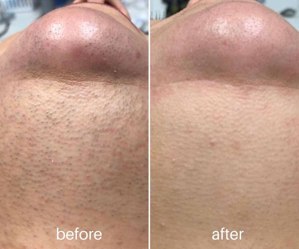 Laser hair removal before and after from Belle Vie’s published treatment page