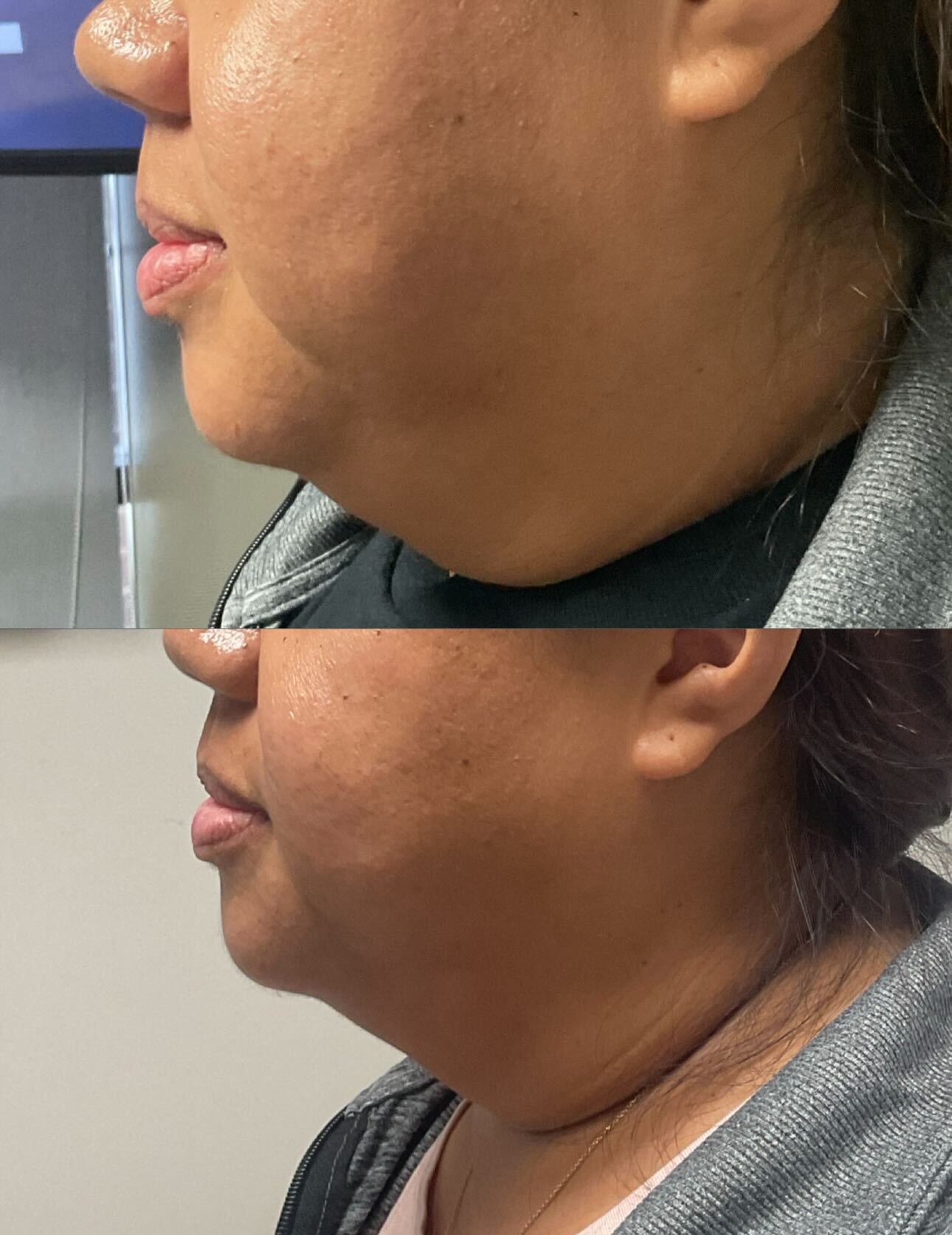 Before and after Kybella chin treatment from Belle Vie’s published gallery