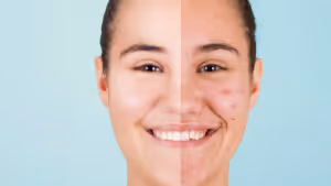 Skin peeling near me, VI peel near me, Vi chemical peel near me