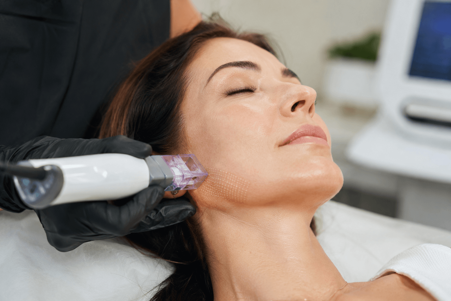 Provider performing RF microneedling with Profound RF to improve sagging jowls and tighten the jawline at Belle Vie Medical in Cerritos, California.