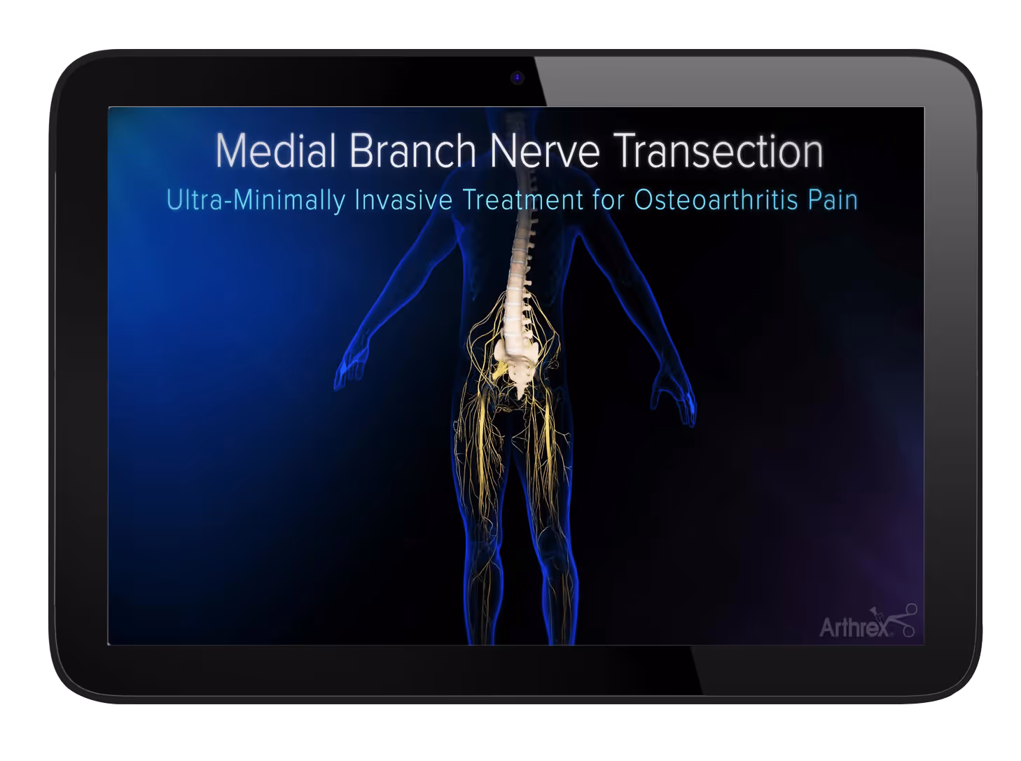 A tablet screen displaying a medical graphic of the human spine and nerve pathways with the title “Medial Branch Nerve Transection” and subtitle “Ultra‑Minimally Invasive Treatment for Osteoarthritis Pain.” The Arthrex logo appears in the corner.