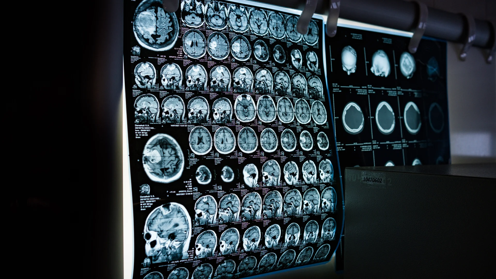 An image of brain xrays in a doctor's office