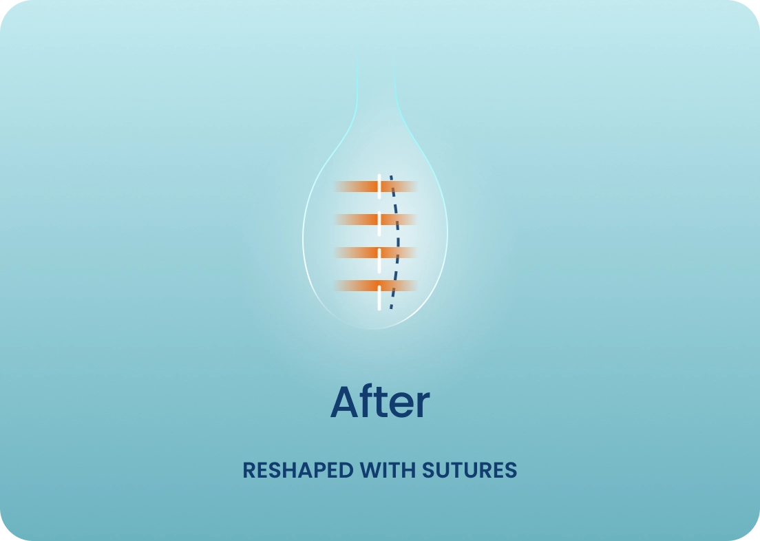 After - full. RESHAPED WITH SUTURES