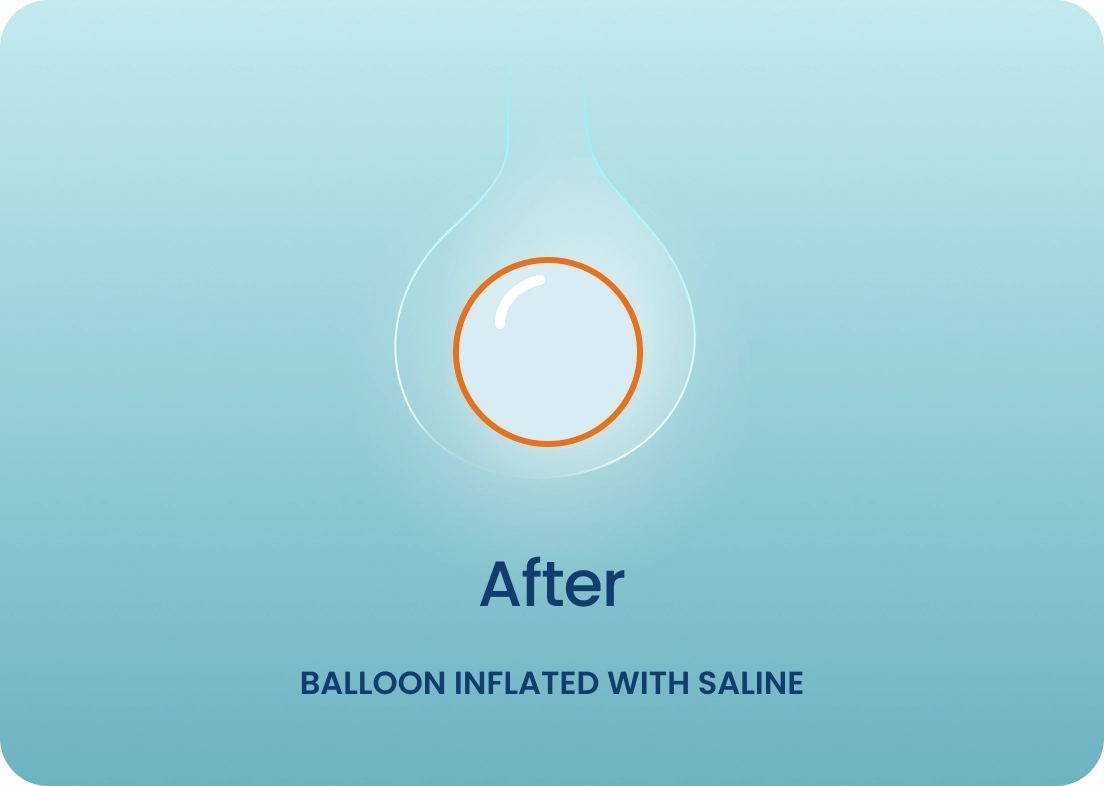 after - BALLOON INFLATED WITH SALINE