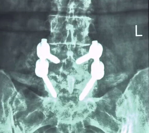 L4/L5 union at 12 months post-grafting with NovaDBMX