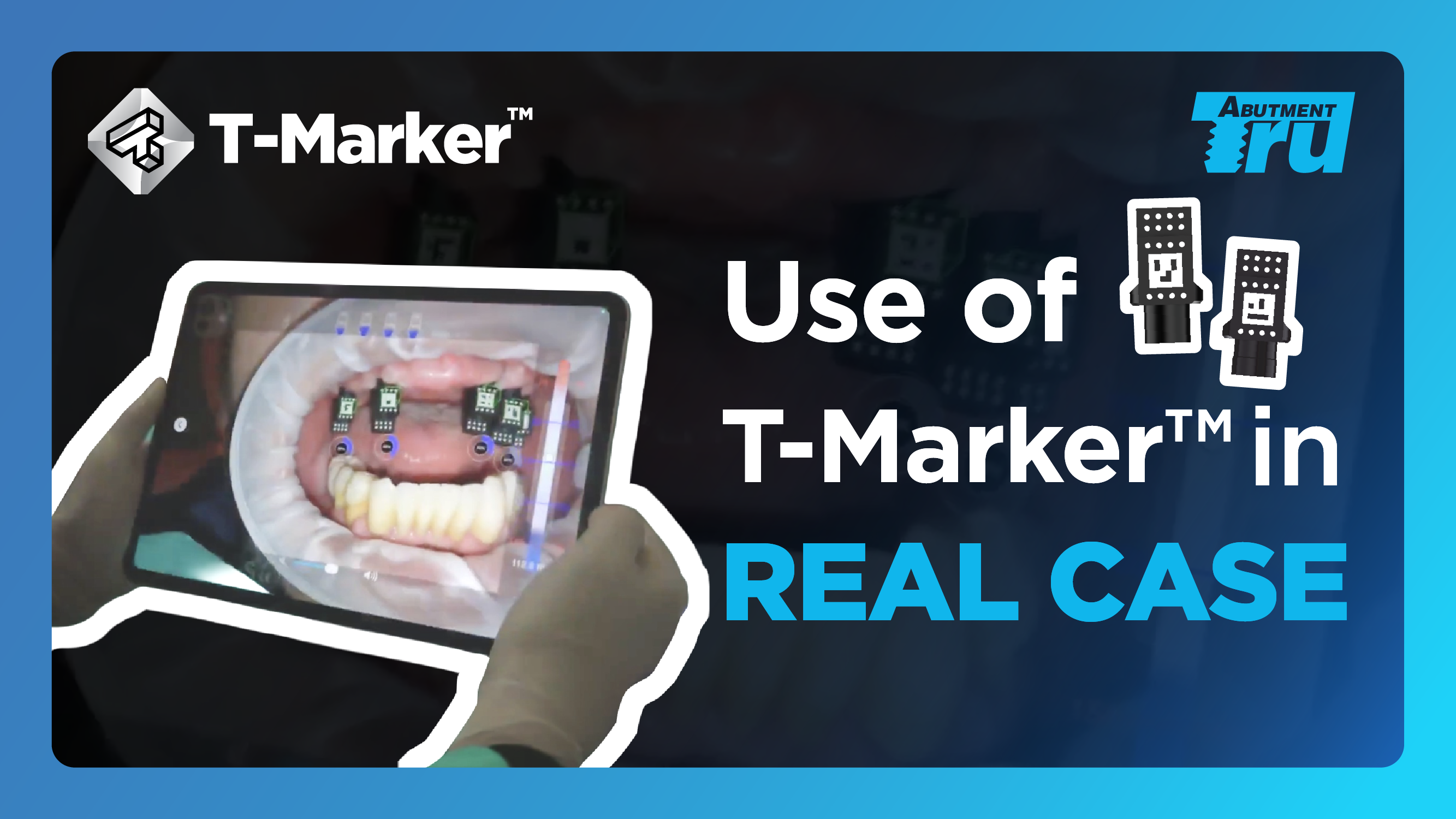 Clinical case video thumbnail, Dr. Kang, T-Marker