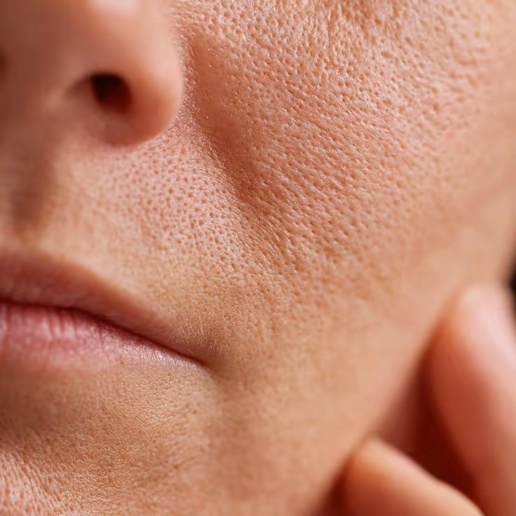 Enlarged pores