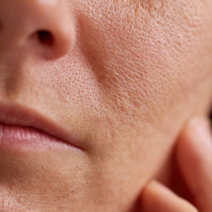 Enlarged pores