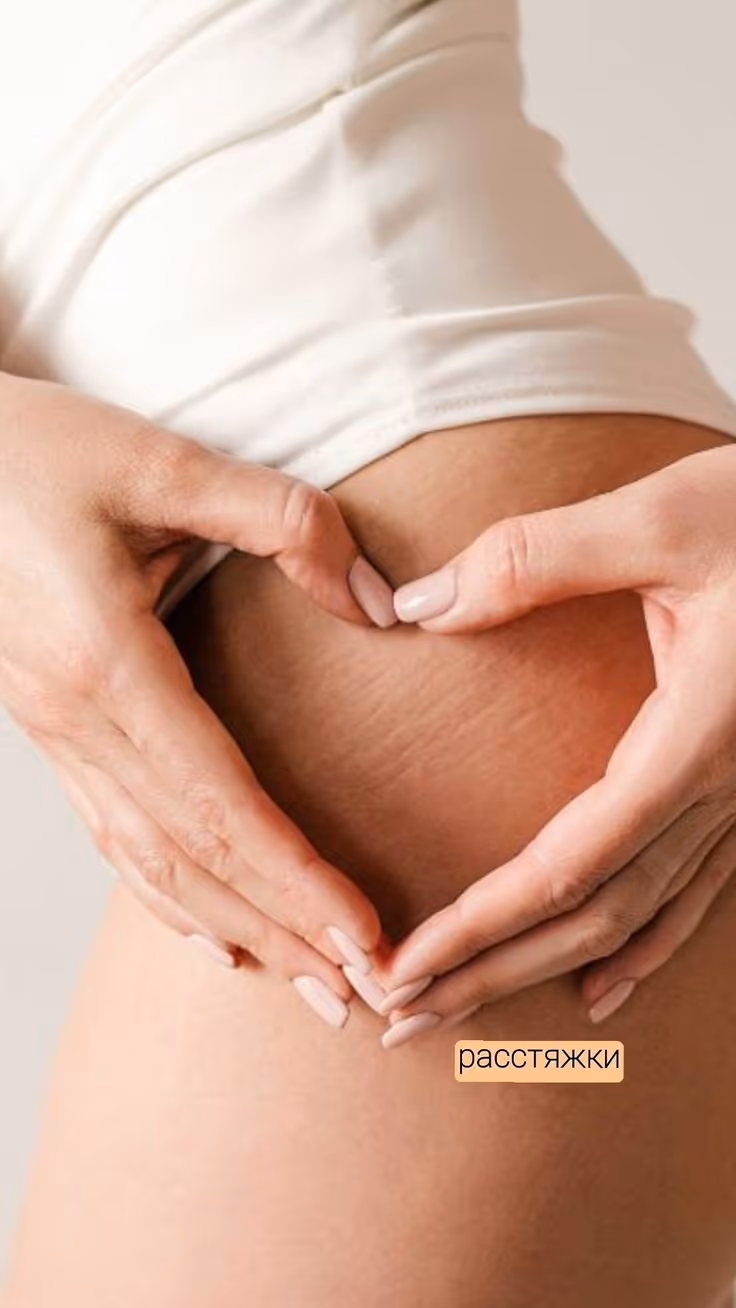 Stretch marks