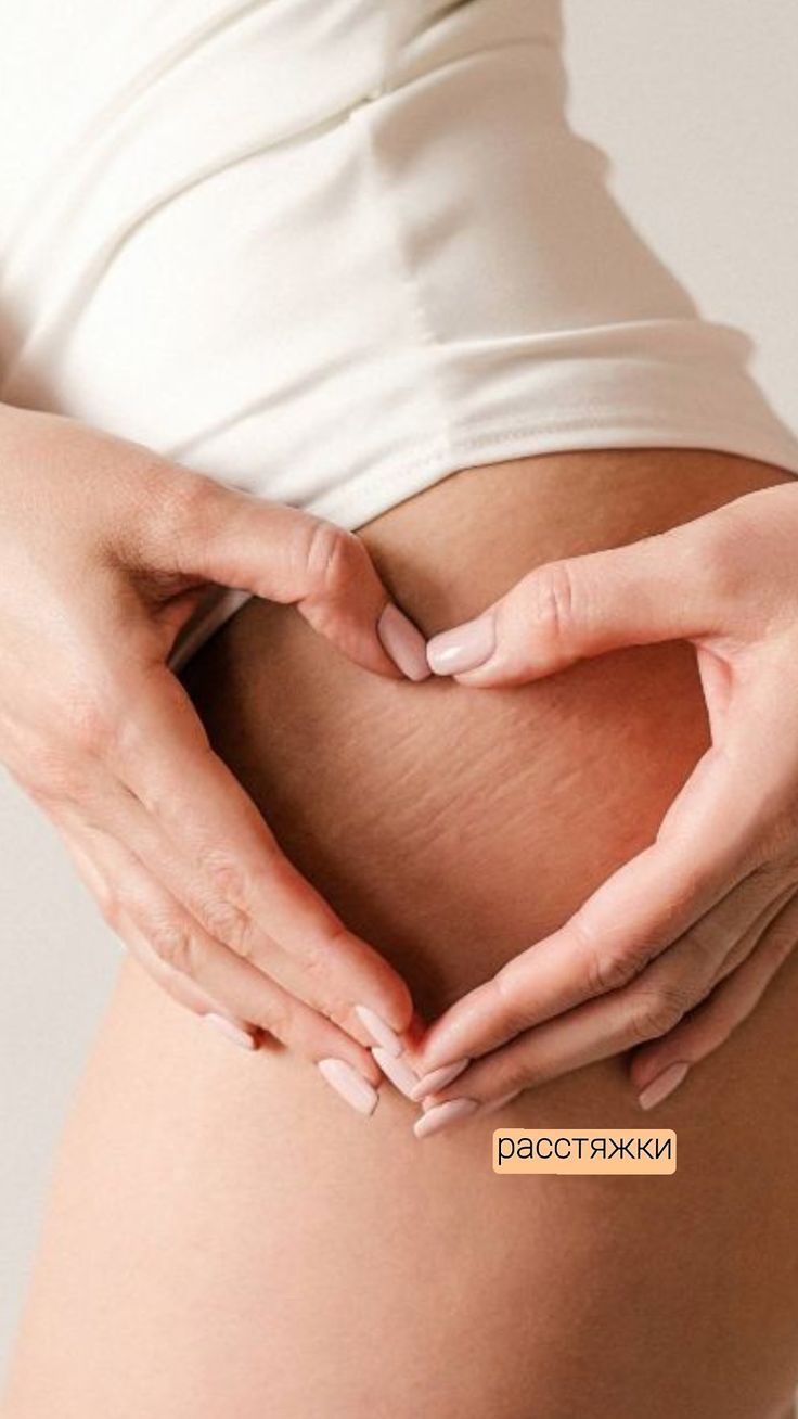 Stretch marks