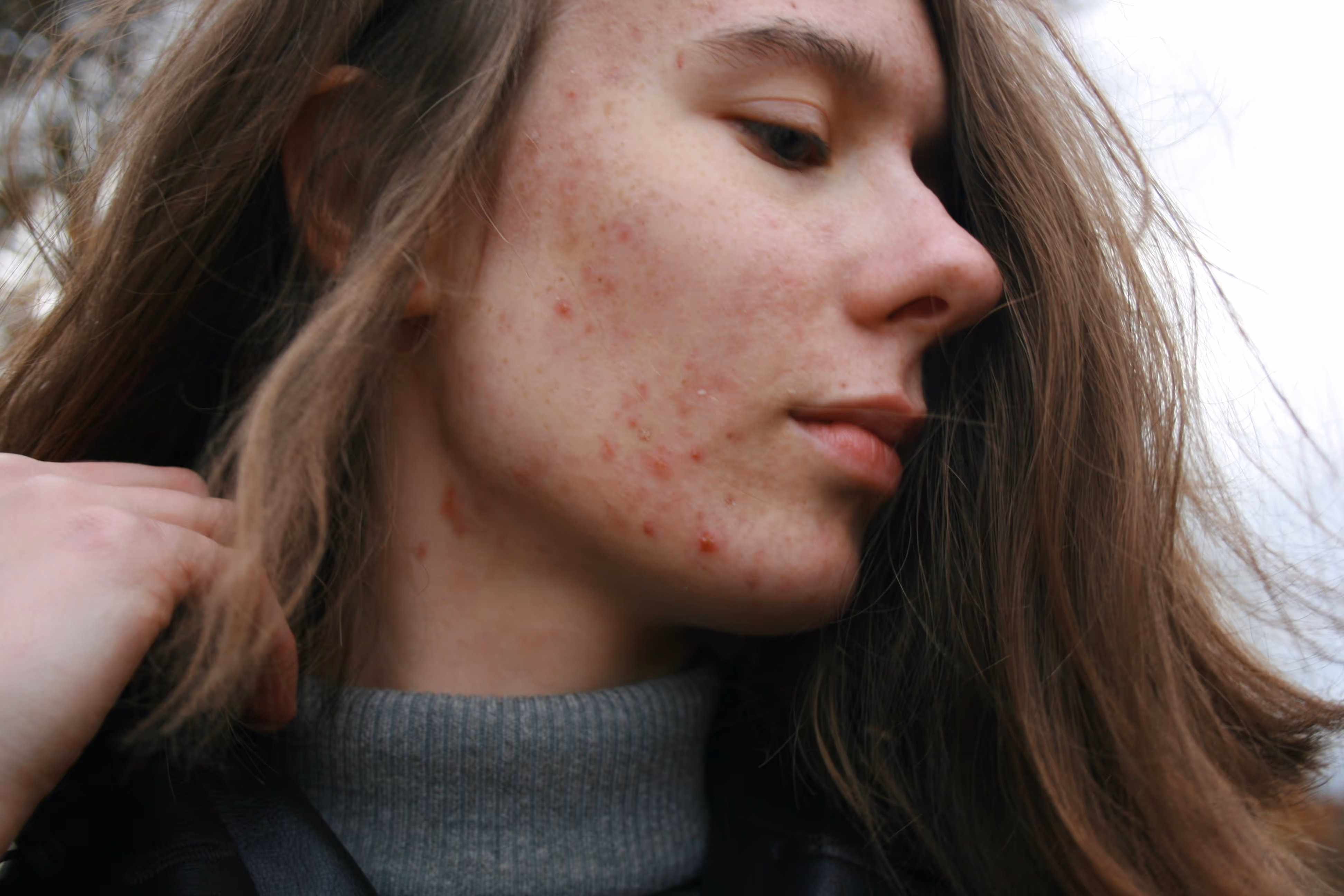 Scarring and skin laxity