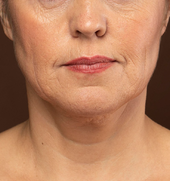 Water retention and bloating