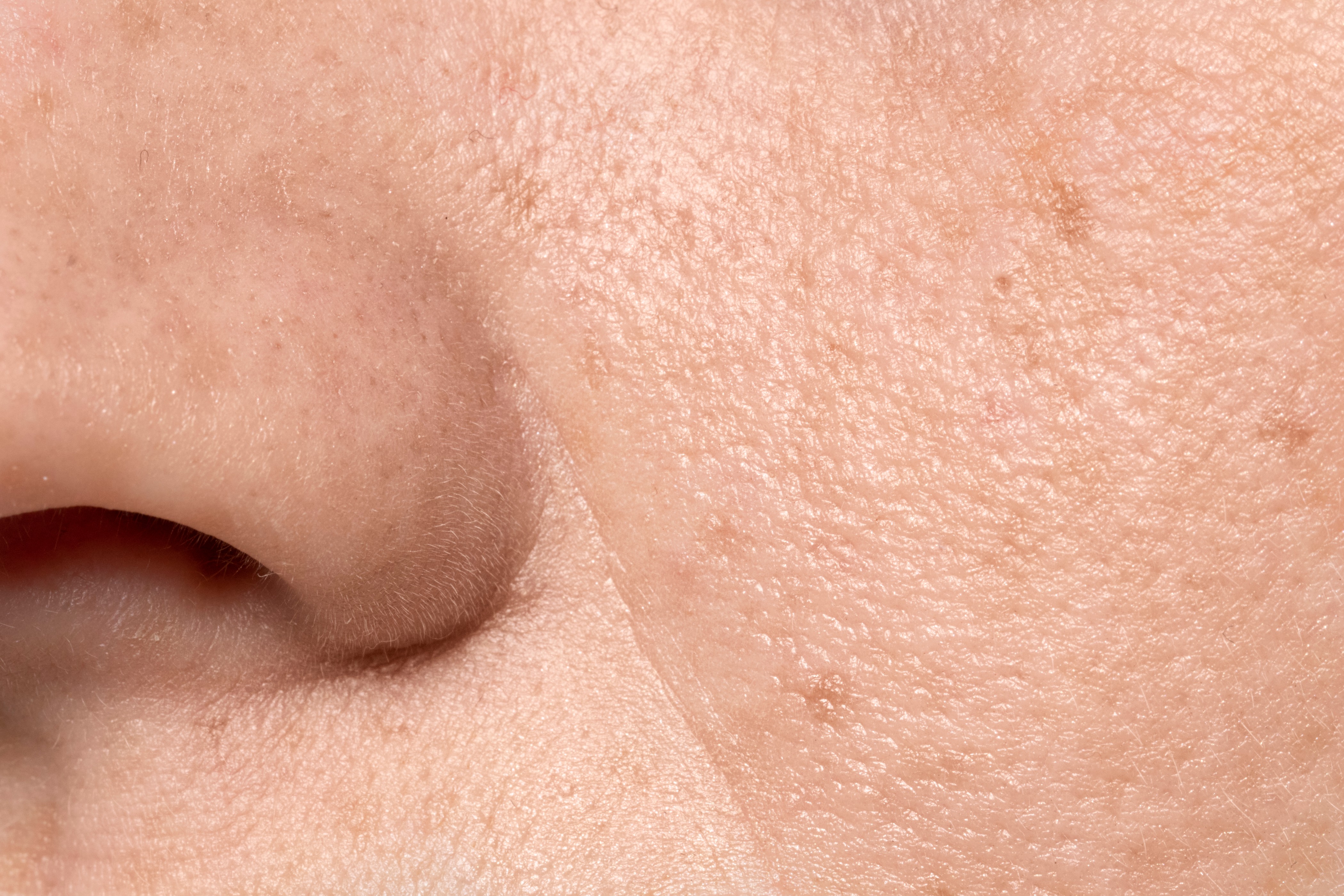Scarring and texture irregularities