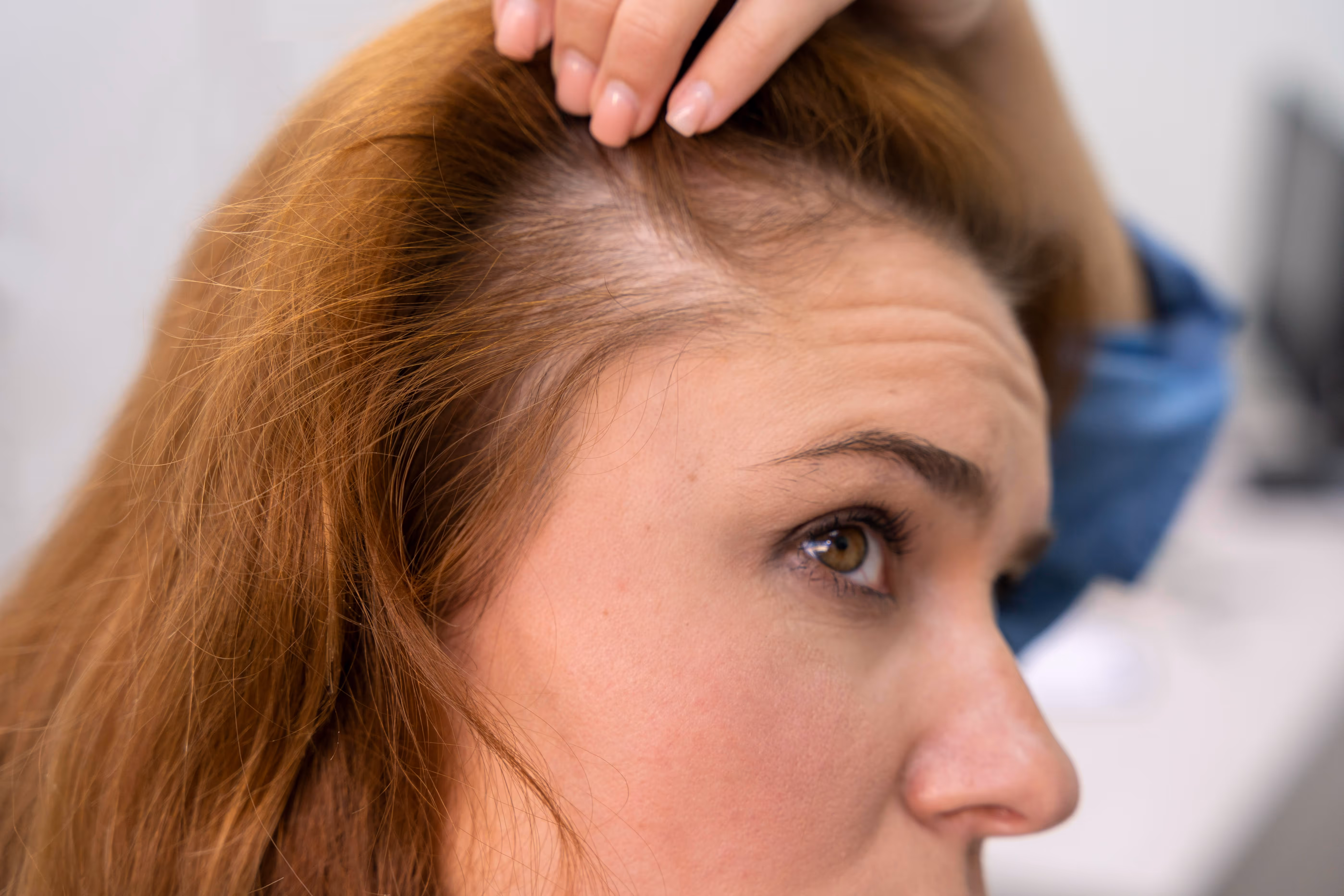 Hairline recession or crown thinning