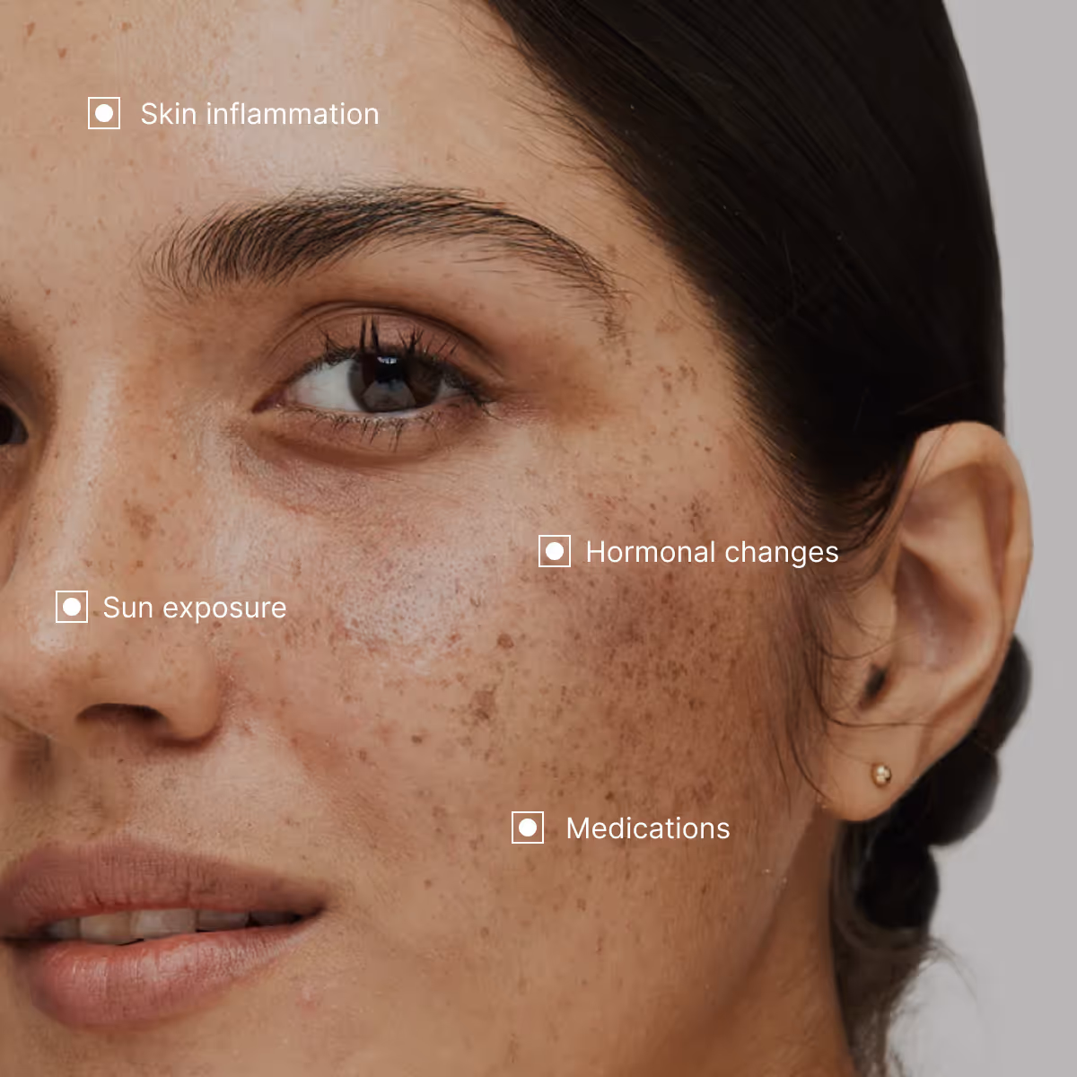 Symptoms and causes of Melasma