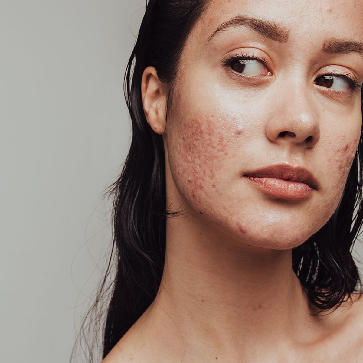 Acne, also known as acne vulgaris, is one of the most common skin conditions worldwide. 