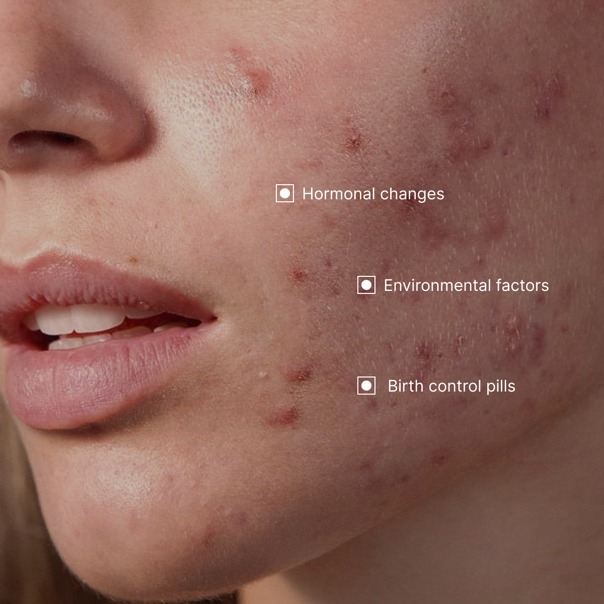 Symptoms and causes of Acne