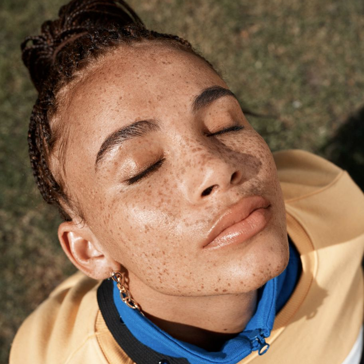 Hyperpigmentation occurs when the skin produces excess melanin deposits, leading to dark spots, age spots, liver spots, or darker patches across the face and body.