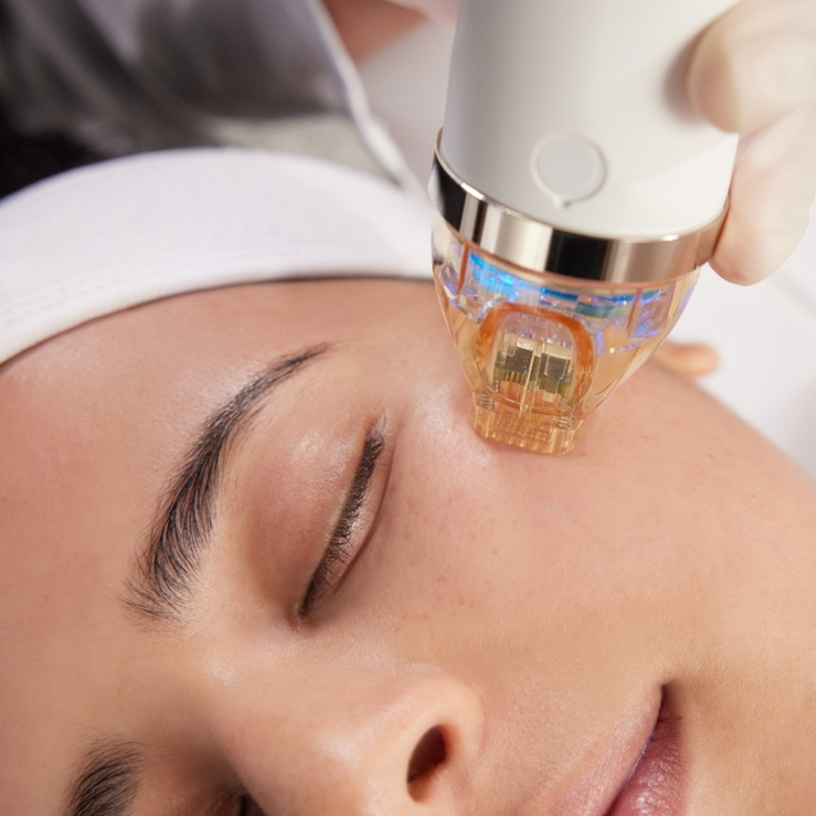 Skin Needling (Microneedling)
