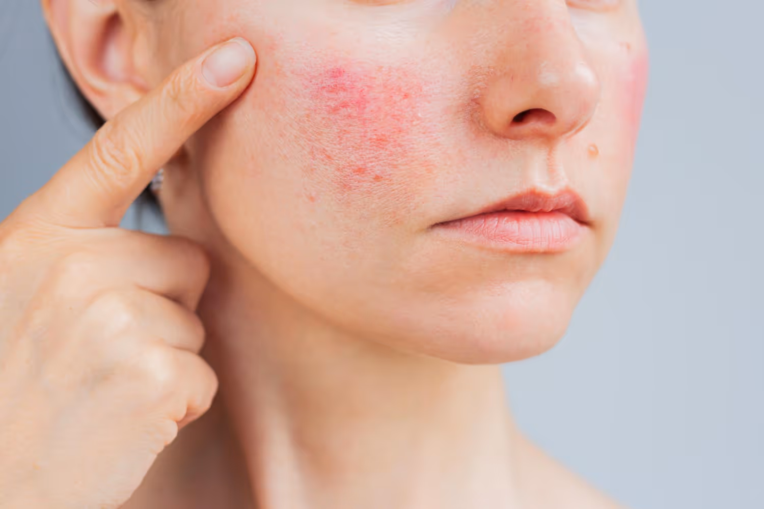 Rosacea Treatment in Dubai