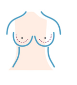 Illustratie borstverkleining ingreep