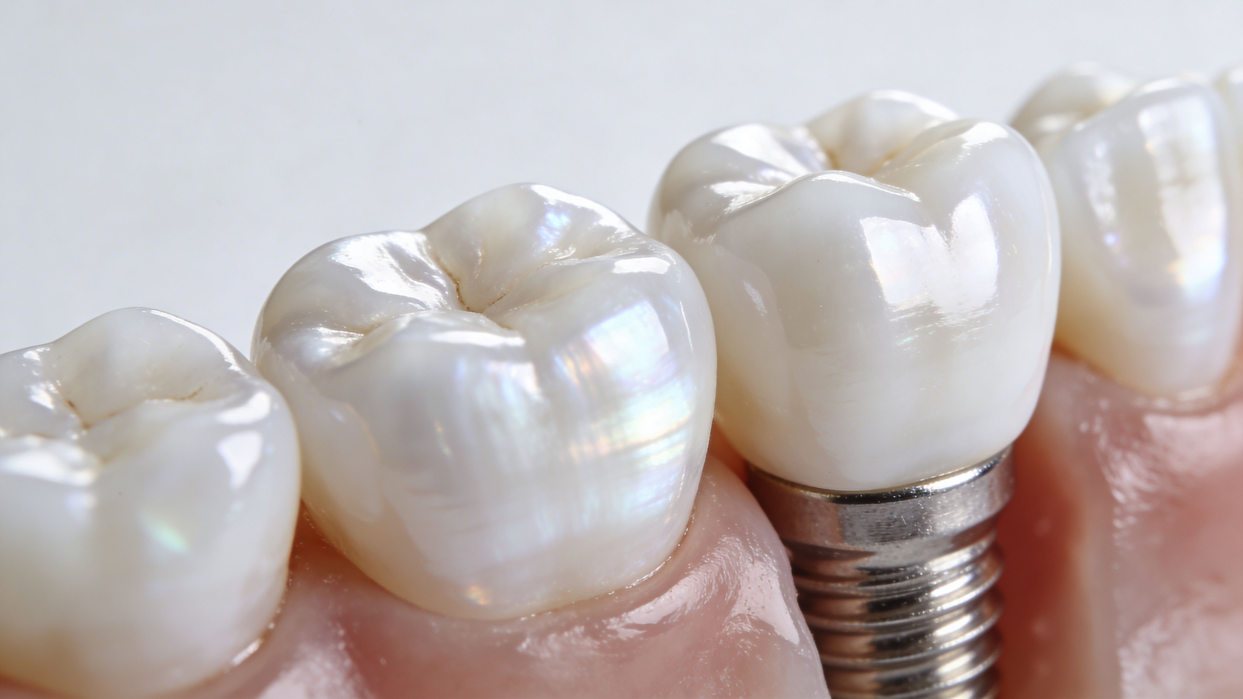 A close-up view of dental implants with realistic teeth and metallic posts inserted into the gums.